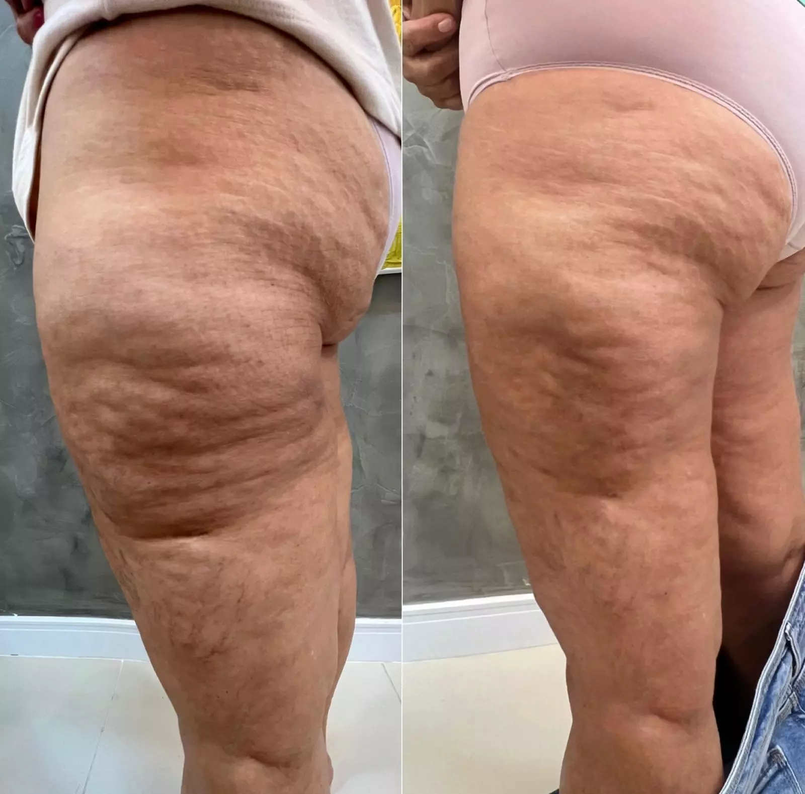 Tratamento para lipedema