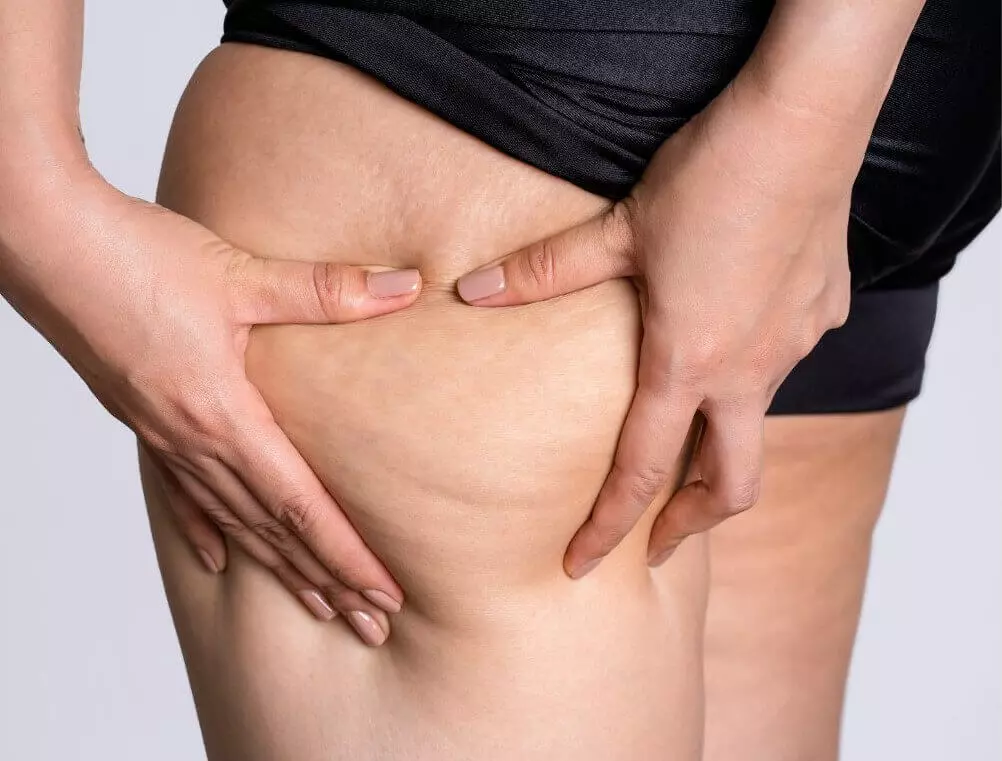 Lipedema em Porto Alegre: Sintomas, Diagnóstico e Tratamento