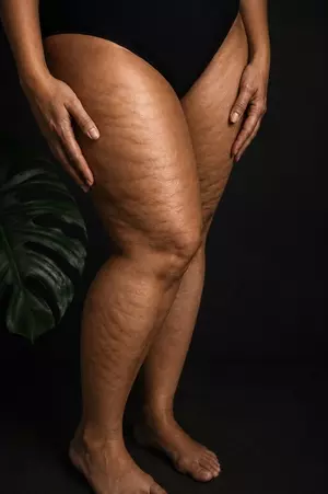 Pernas Lipedema