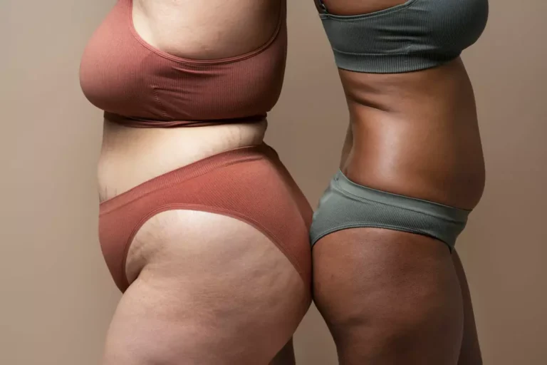 Lipedema