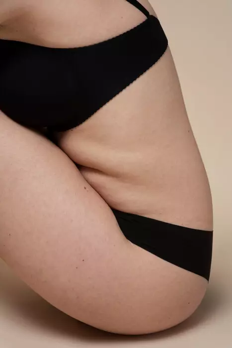 Lipedema
