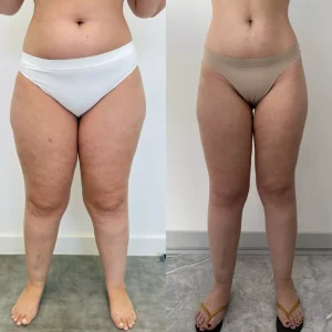 Antes e depois Tratamento para lipedema