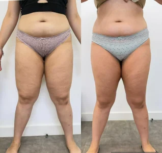 Antes e depois Tratamento para lipedema
