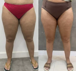 Antes e depois Tratamento para lipedema
