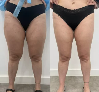 Antes e depois Tratamento para lipedema