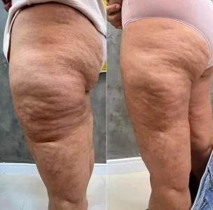 Tratamento para lipedema