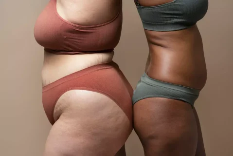 Lipedema